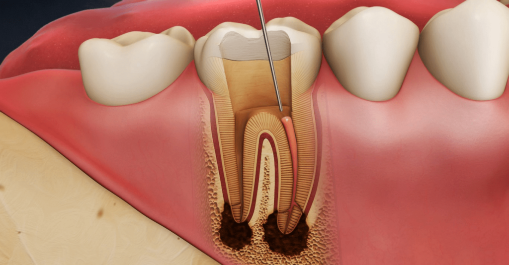 Endodontie Stomatologie Râmnicu Sărat Dr. State