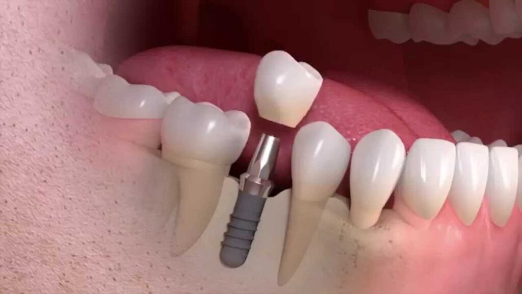 Implantologie dentară - Dr. State Râmnicu Sărat