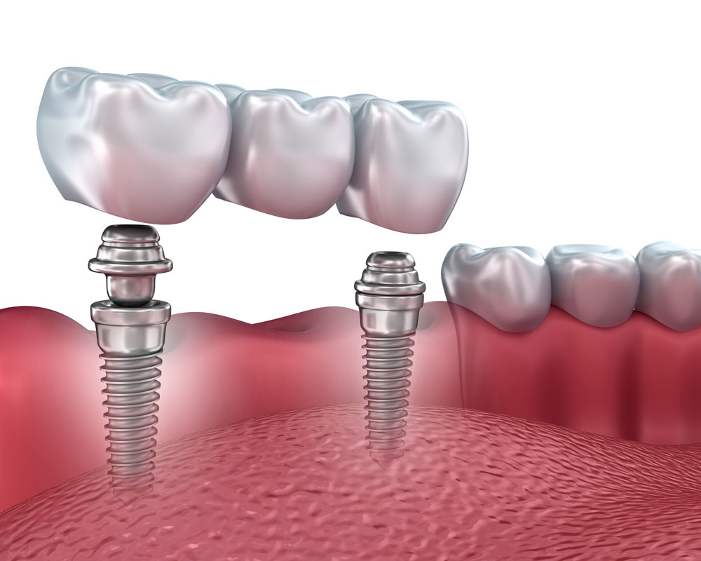 Implant Râmnicu Sărat - Stomatologie Dr. State