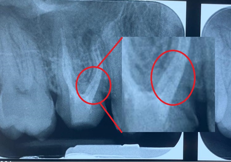 Fractura corono radiculara nepenetrata, fara expunerea pulpei stomatologie ramnicu sarat Dr. State