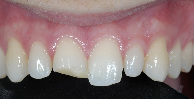 Fractura in smalt si dentina stomatologie ramnicu sarat dr state