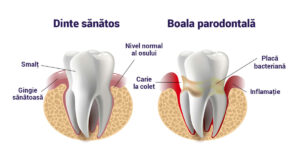 boala parodontalĂ