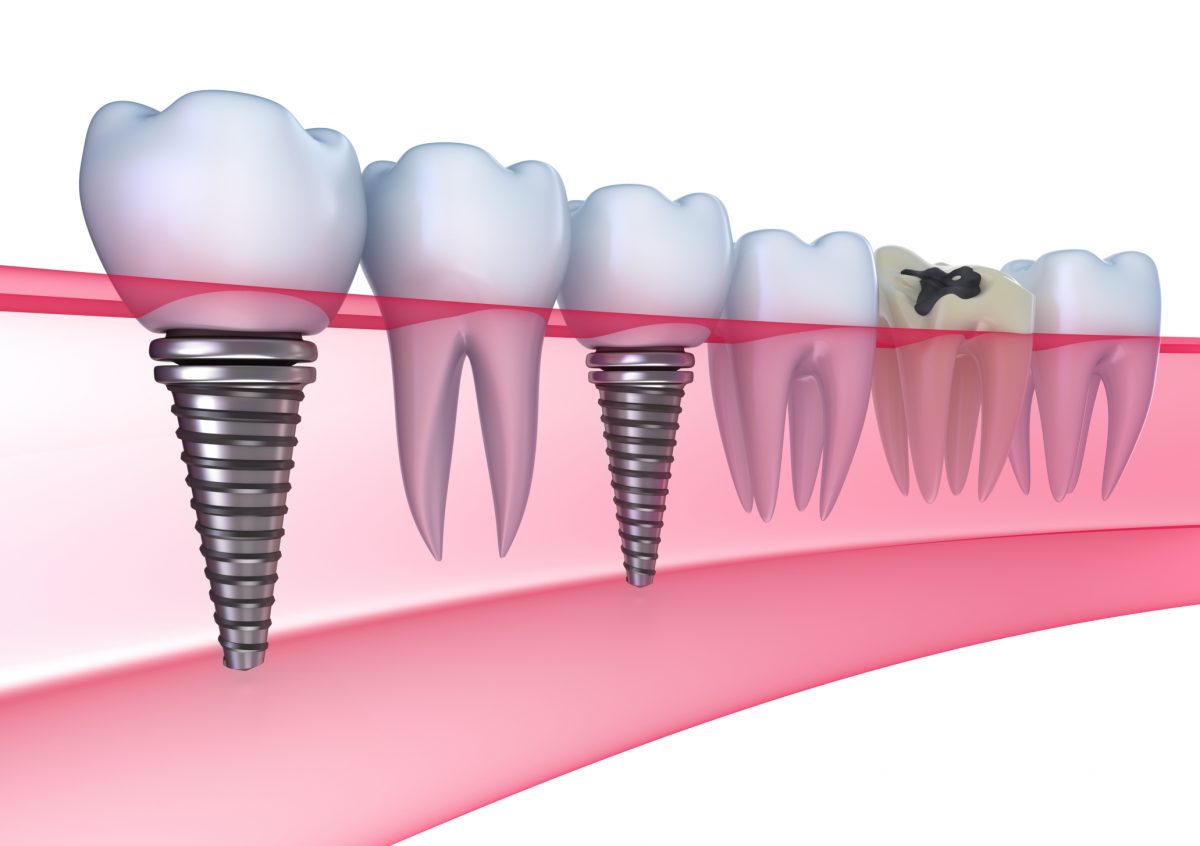 Implantul Dentar Avantaje