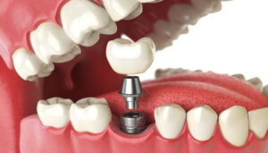 tooth implant. dental concept. human teeth or dentures.