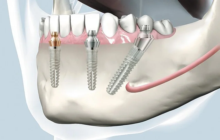 Implantele dentare etape de tratament Stomatologie Râmnicu Sărat