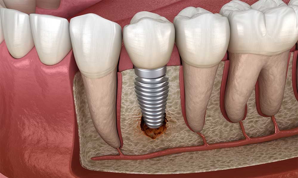 extractia dentara dr state ramnicu sarat