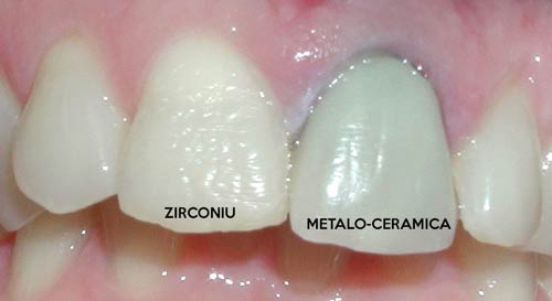 Dinti din zirconiu vs portelan Stomatologie Râmnicu Sărat