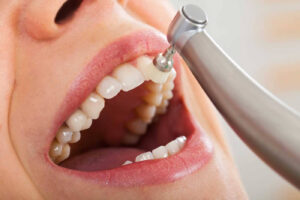 Ce este demineralizarea dinților