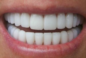 Zirconiul dentar și beneficiile sale dinți, coroană și implant din zirconiu