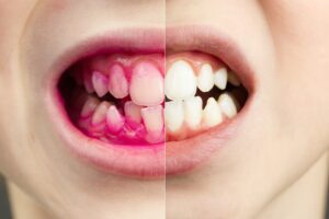 Cum să ne spălăm corect pe dinți 6 greșeli frecvente de evitat