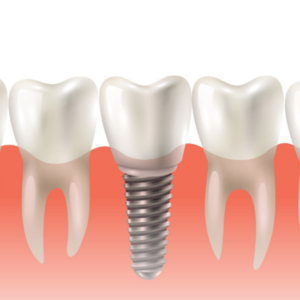 Dentist Râmnicu Sărat IMPLANTOLOGIE