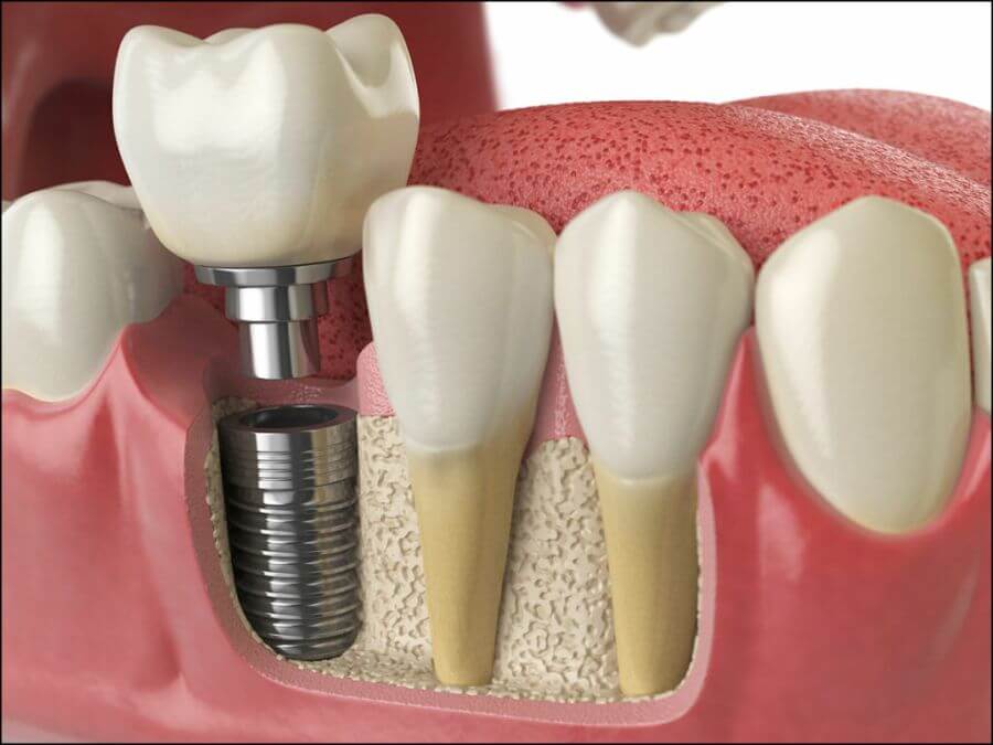 Implantele dentare etape de tratament Stomatolog Ramnicu Sarat