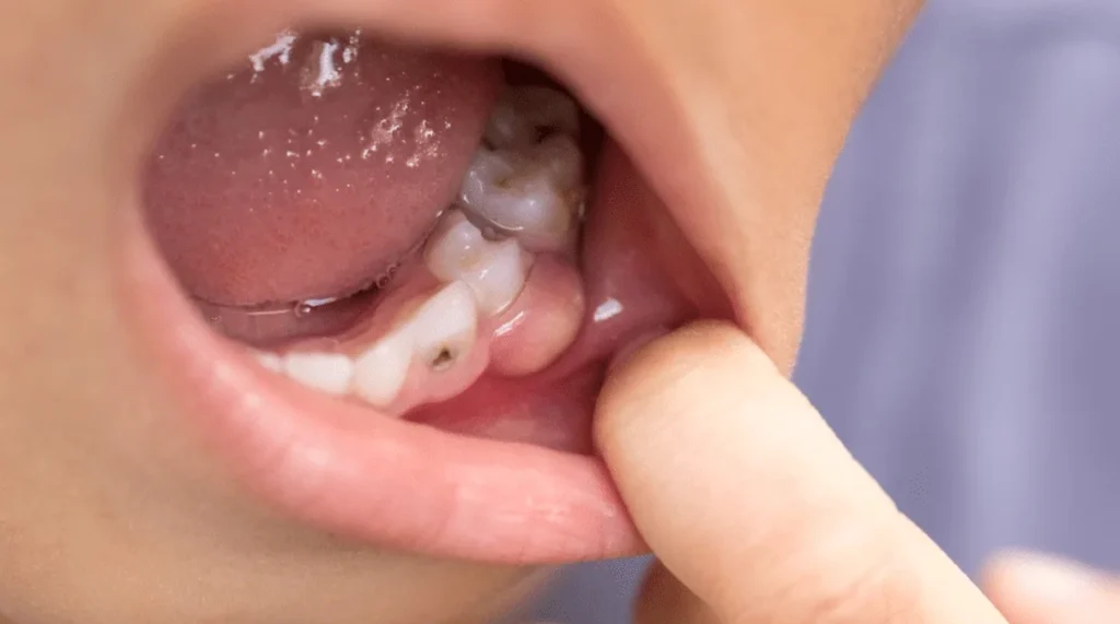 Abcesul dentar la copii cauze, simptome și tratament