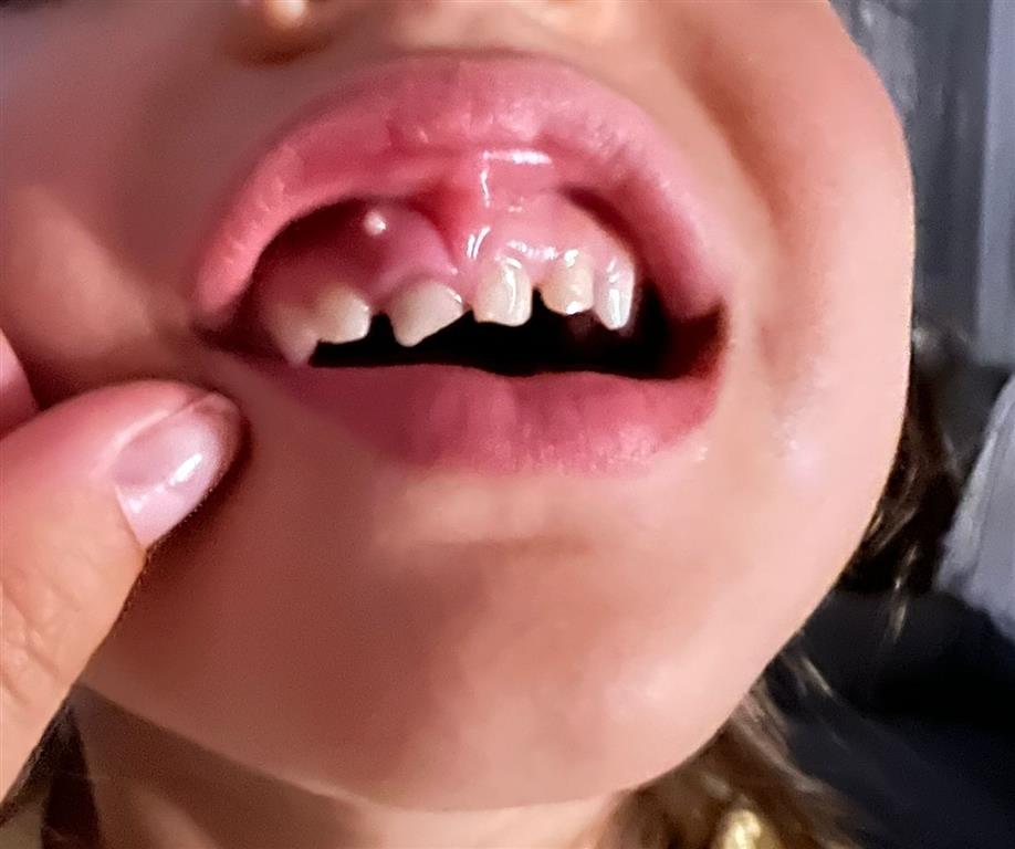Abcesul dentar la copii cauze, simptome și tratament DrState