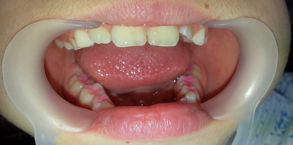 Totul despre sigilarea dentară la copii DrState.ro