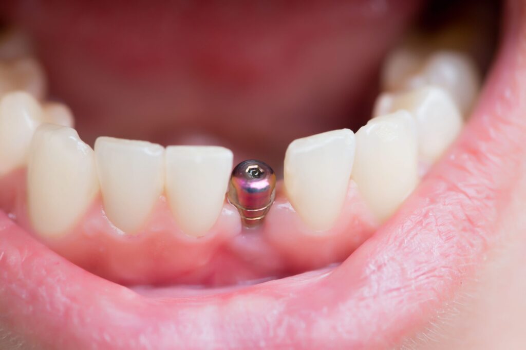 implant dentar