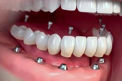 Proteza Dentară vs Implant Dentar Stomatologie Ramnicu Sarat DrState