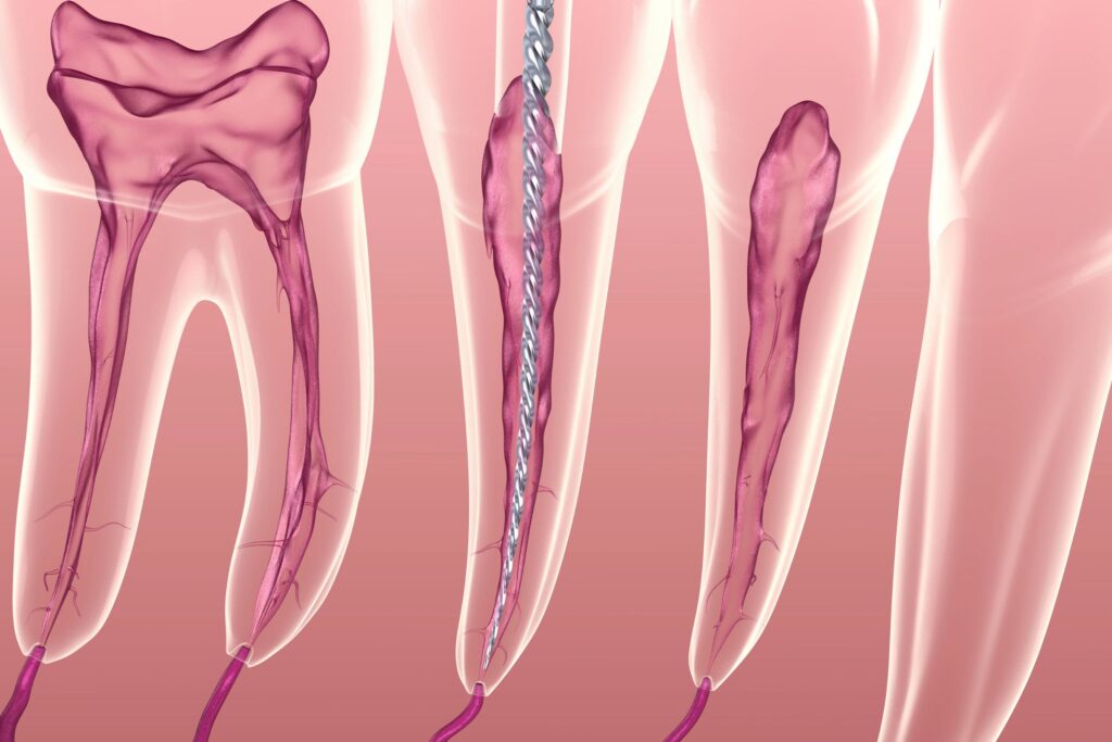 Durerea după scoaterea nervului ce e normal și ce nu