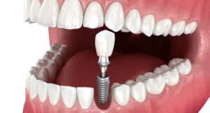 Implantul dentar soluția modernă