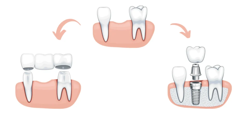 Implanturi vs Punti vs Proteze dentare